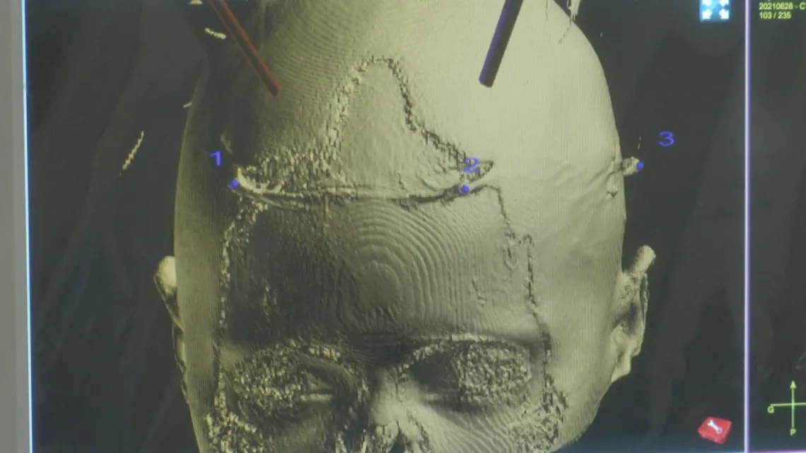 RÉPARER LE CERVEAU